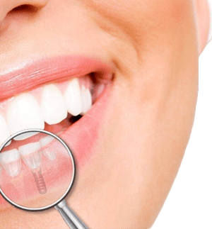 implant dentaire tunisie idealmed